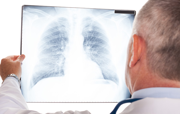 什麼是肺癌