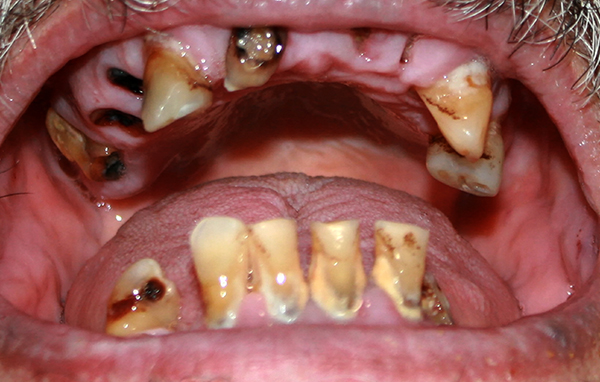 牙周病的定義